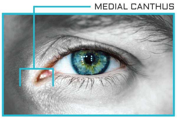 Medial-Canthus